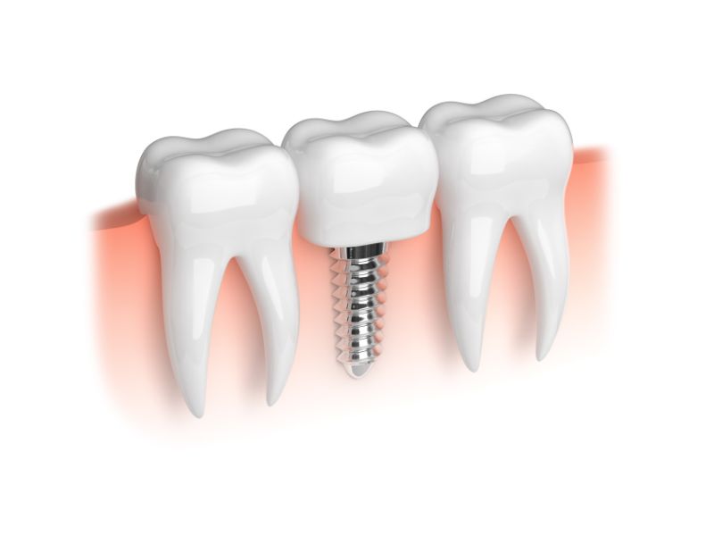 ДЛЯ ЧЕГО НУЖЕН ЗУБНОЙ ИМПЛАНТАТ