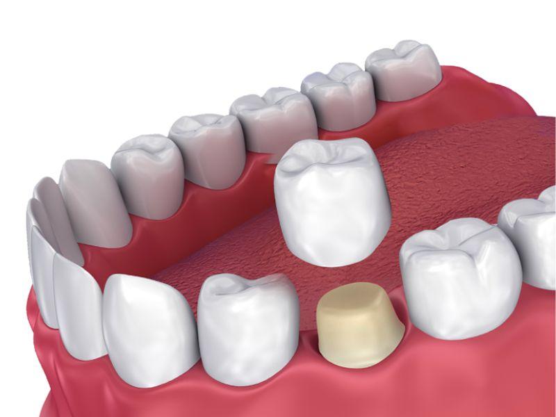 ЗУБНЫЕ КОРОНКИ: ПОКАЗАНИЯ, ОСОБЕННОСТИ